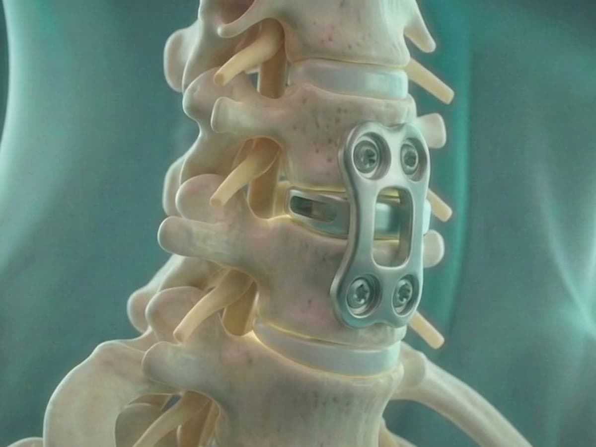 Illustration of the cervical spine from the front with a plate and screws in place