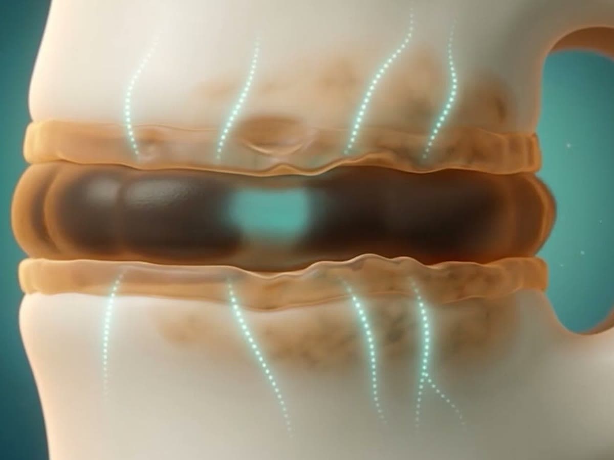 Illustration of a worn, darkened disc between two vertebrae