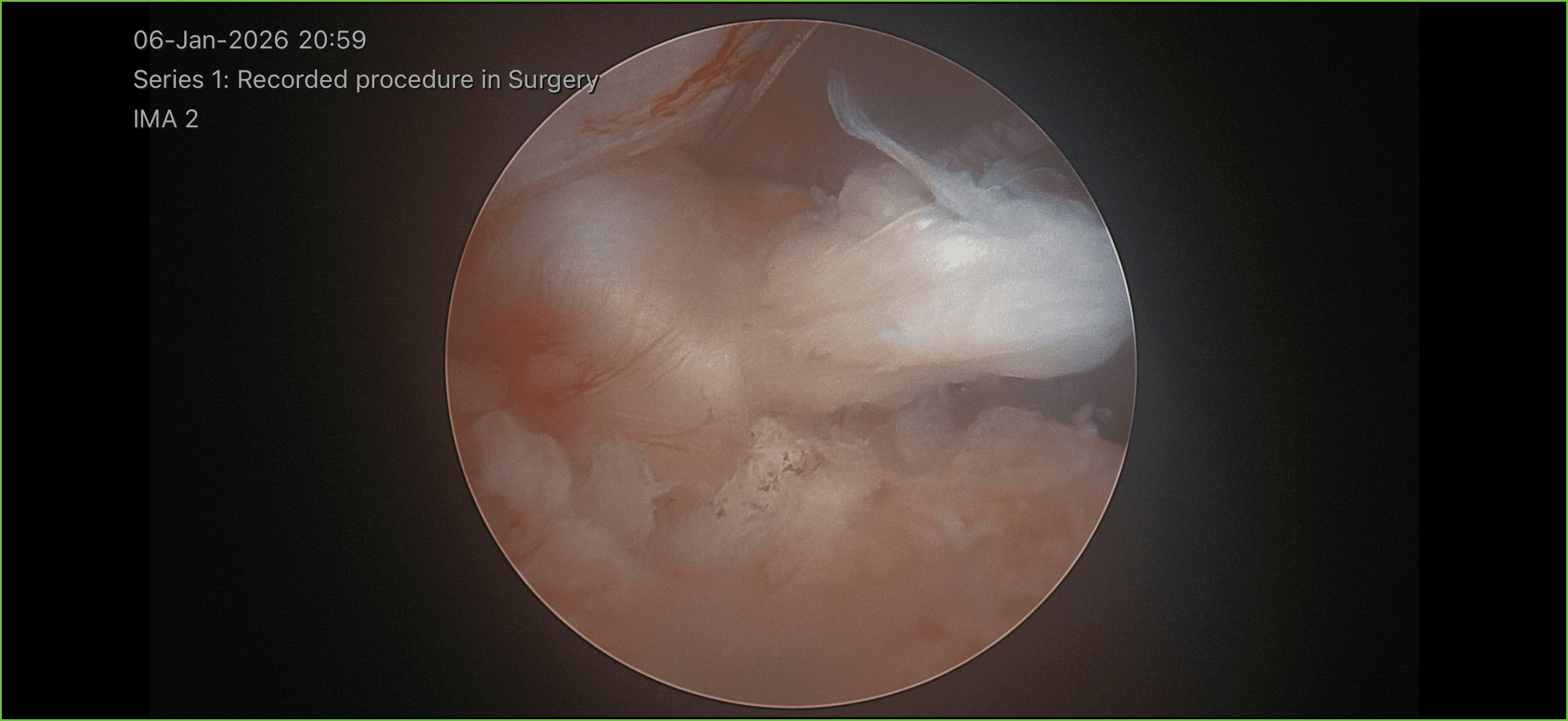 Endoscopic view inside the spinal canal showing the disc being removed during endoscopic spine surgery