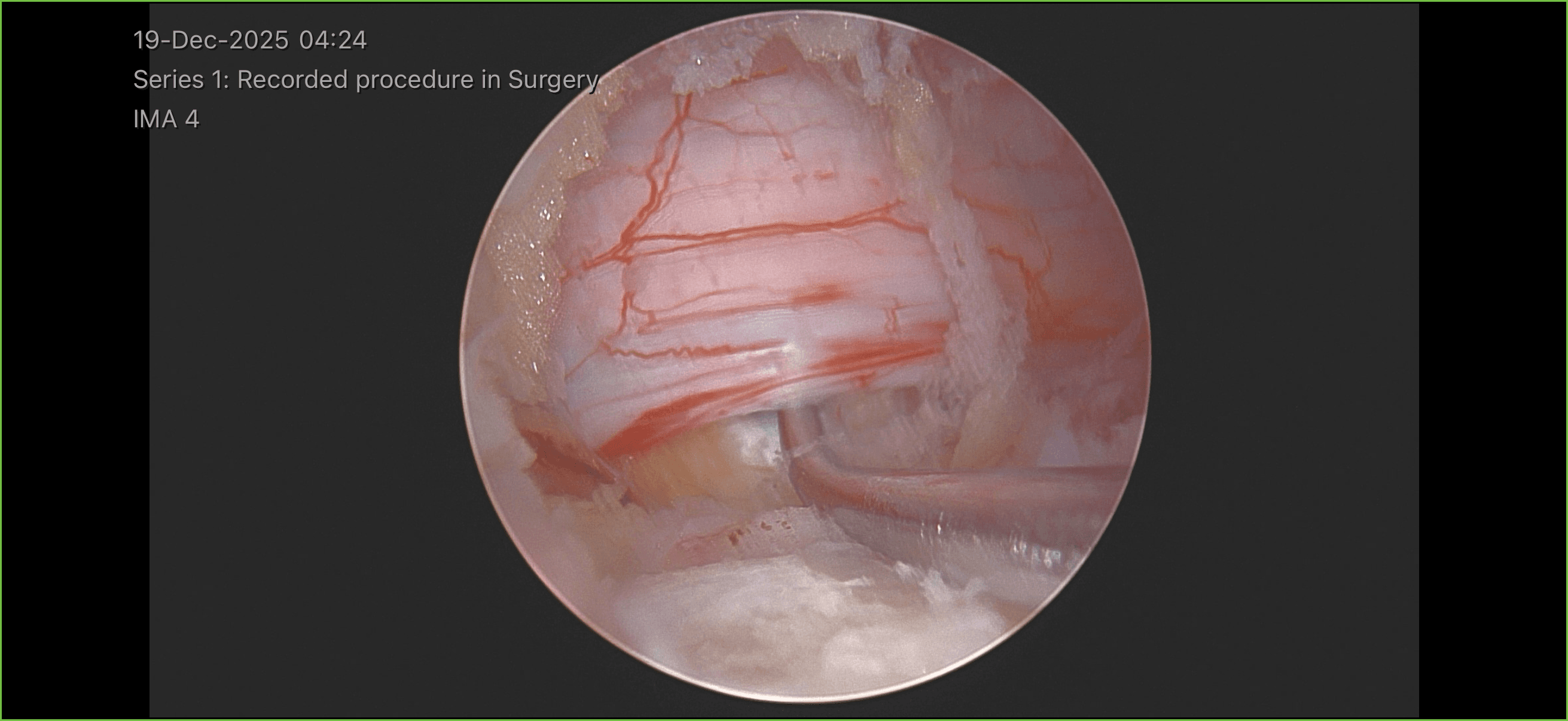 Endoscopic view inside the spinal canal showing the spinal nerve during endoscopic spine surgery
