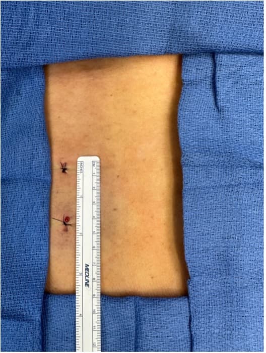 Two small incisions used in endoscopic spine surgery, showing the minimal size of the portals