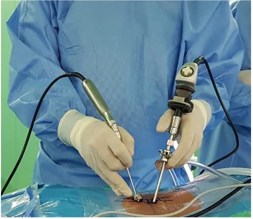 Endoscopic instruments and equipment used during endoscopic spine surgery