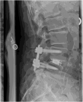Post-operative X-ray after endoscopic TLIF showing the interbody cage and pedicle screws in position