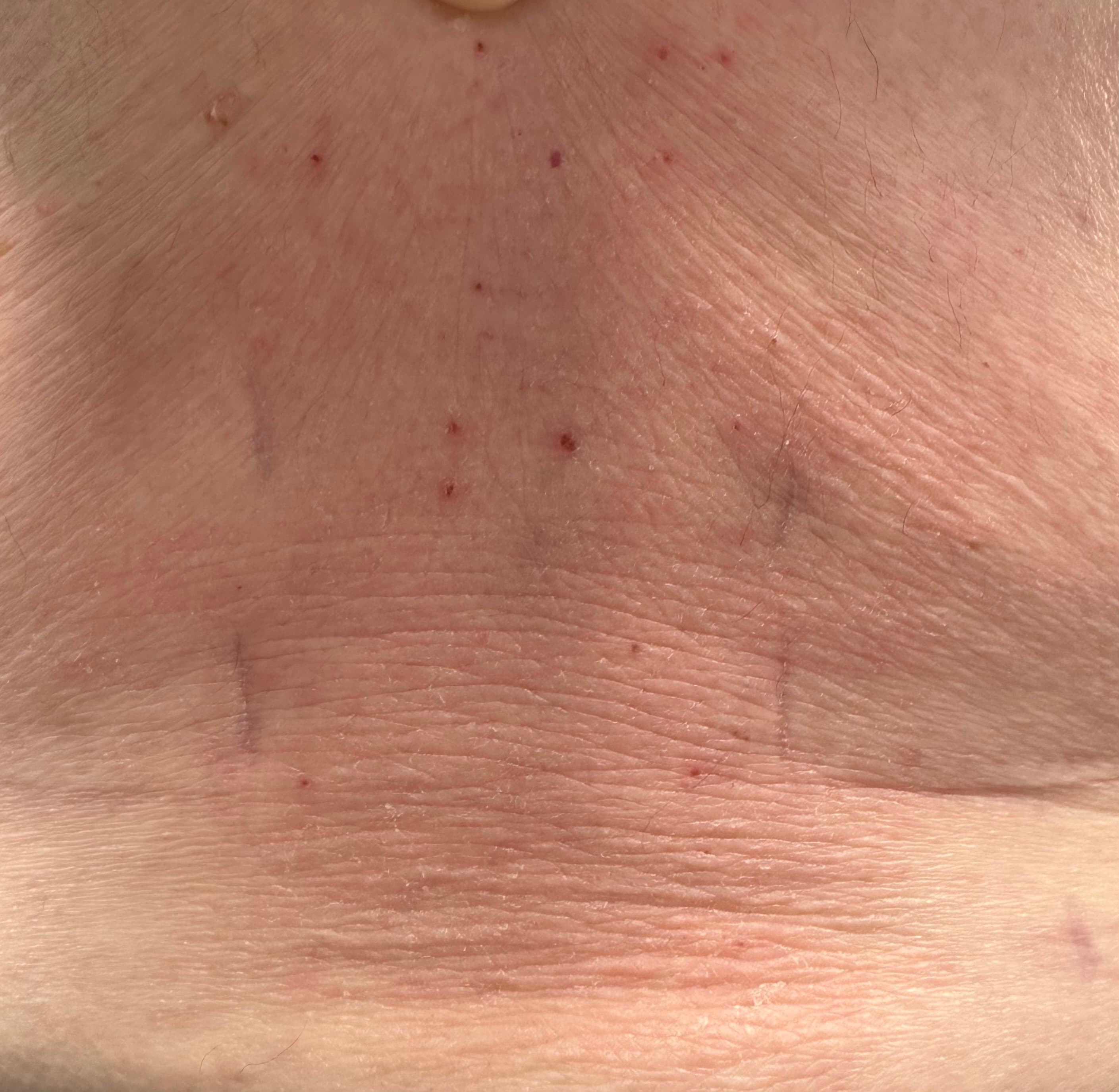 Healed skin incisions after endoscopic TLIF showing the small scars from the minimally invasive portals