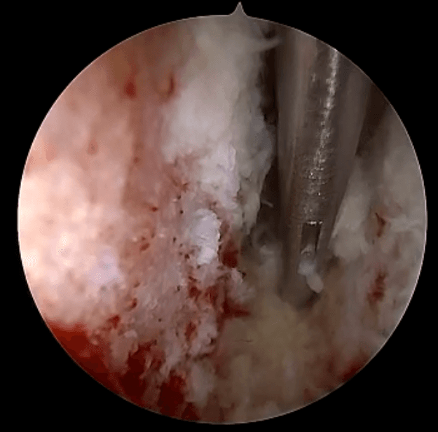 Endoscopic intraoperative view of the disc space being prepared during endoscopic TLIF